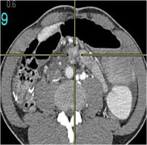 Paraganglioma
