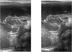 Congenital Hypertrophic Pyloric Stenosis