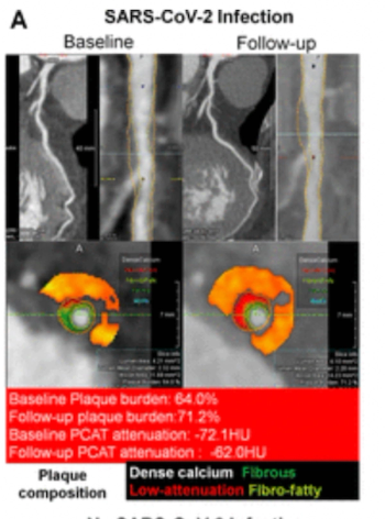 New CT Angiography Study Shows Impact of COVID-19 on Coronary Inflammation and Plaque