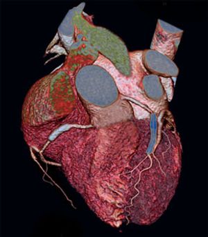 Reliable In-Stent Lumen Visualization With Dual Source CT Coronary Angiography