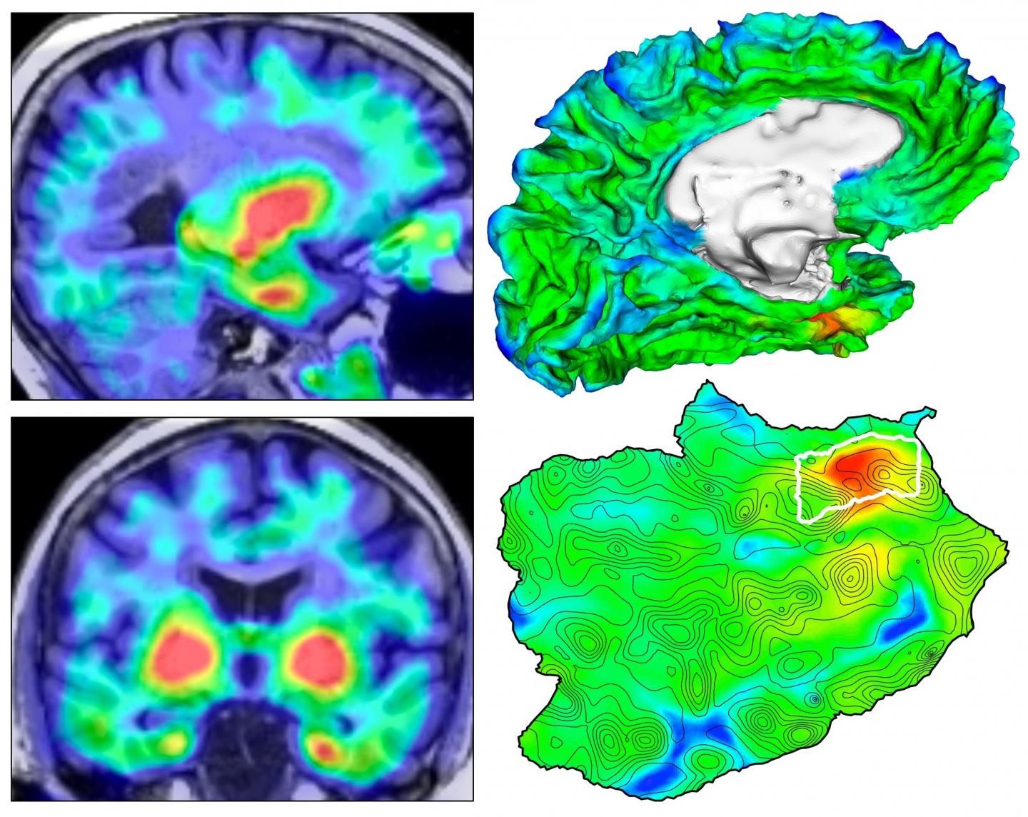 PET Imaging Reveals Site Tau's Emergence in Alzheimer's
