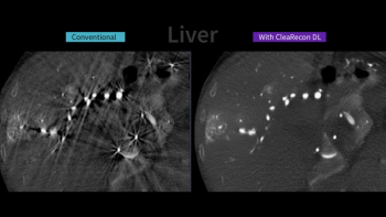 FDA-Cleared AI Software Targets Streak Artifacts in Cone-Beam CT