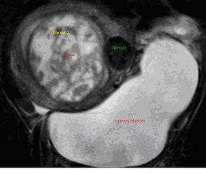 Unusual Presentation of Uterine Fibroids