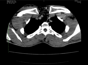 Image IQ Quiz (Video): Patient Presents with Enlarging Neck and Shoulder Region