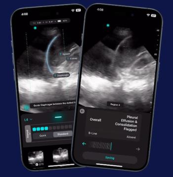 FDA Clears Ultrasound AI Detection for Pleural Effusion and Consolidation