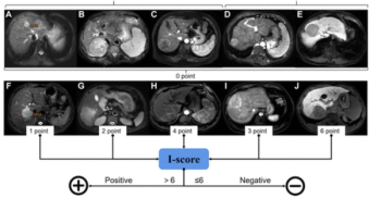 Emerging MRI Scoring System May Help Predict Recurrent and Metastatic Hepatocellular Carcinoma