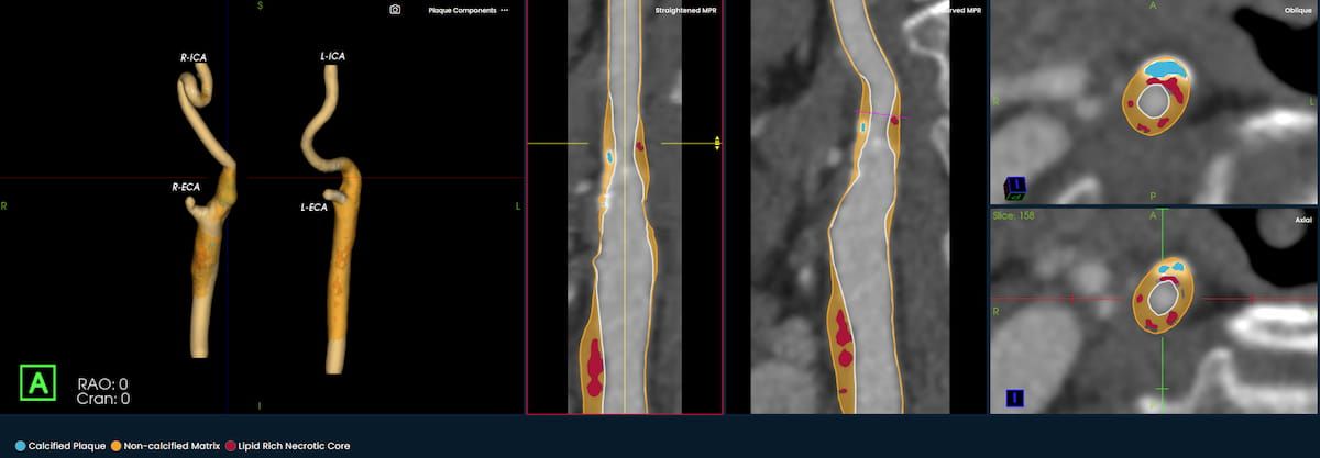 Emerging AI Software for CT Plaque Analysis ‘Revolutionizes’ Carotid Artery Assessment