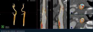 Emerging AI Software for CT Plaque Analysis ‘Revolutionizes’ Carotid Artery Assessment