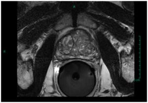 Granulomatous Prostatitis 