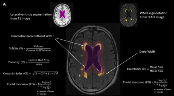 MRI Study Suggests Shape of White Matter Hyperintensities May Be Predictive of Cognitive Decline