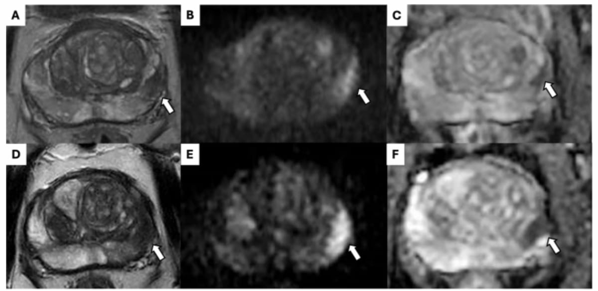 Prostate MRI Study Shows Prognostic Value of PRECISE Scoring System for Active Surveillance of PCa