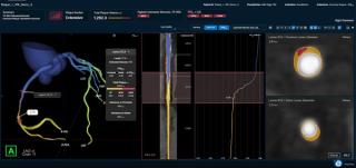 FDA Clears AI-Enabled FFR-IQ Software for Estimating Fractional Flow Reserve from CCTA