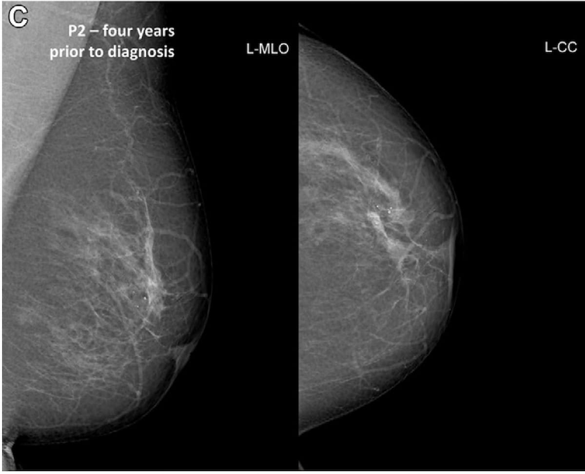 Photo of Un logiciel d’IA prédit un tiers des cas de cancer du sein jusqu’à deux ans avant le diagnostic