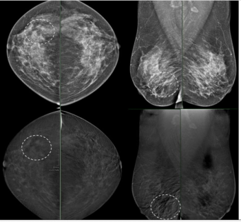 Contrast-Enhanced Mammography Study Reveals 24 Percent Lower Sensitivity with Moderate/Marked BPE