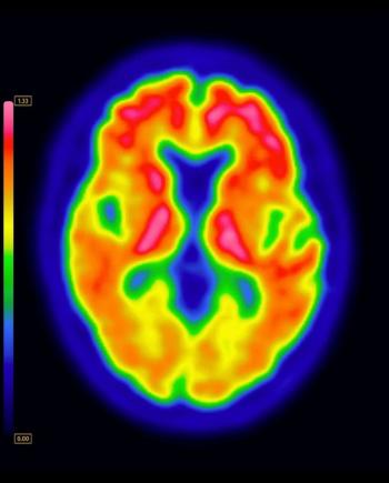 FDA Approves Multiple New Indications for the Brain PET Imaging Agent Vizamyl