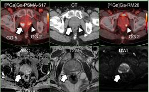 Comparative Study Shows Merits of PSMA PET/CT for Local Staging of Intermediate and High-Risk PCa