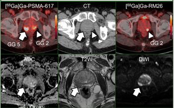 Comparative Study Shows Merits of PSMA PET/CT for Local Staging of Intermediate and High-Risk PCa
