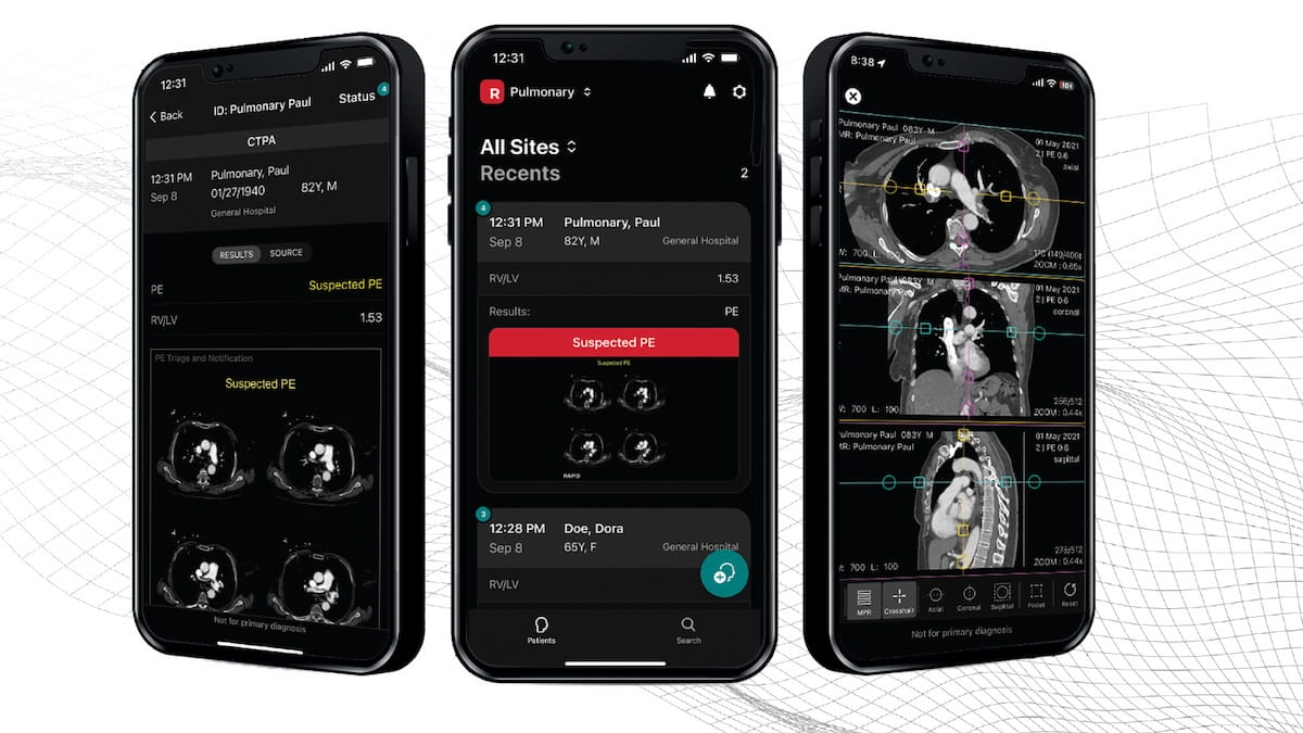 New Multicenter Study Shows Viability of AI Tool for Detecting Central PE on CT