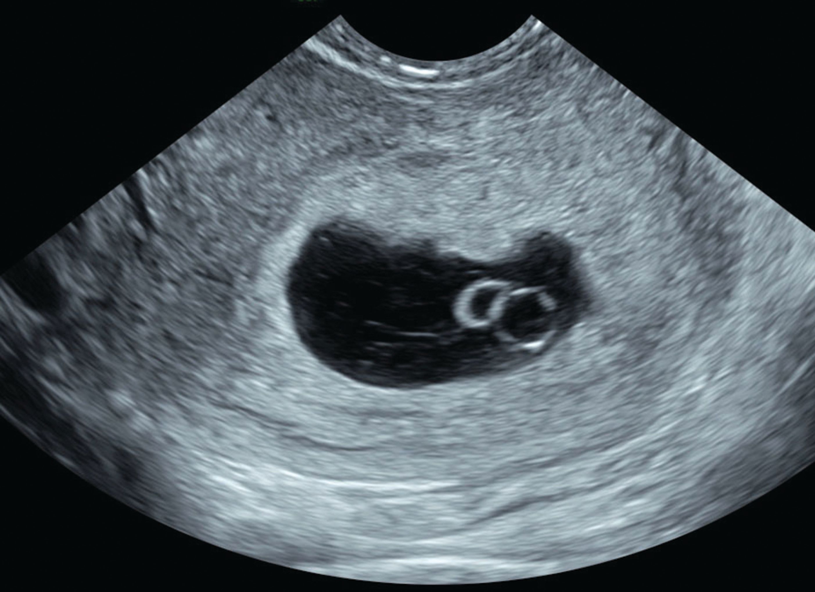 What Does An Early Miscarriage Look Like On Ultrasound at Rachel