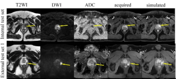 Can Generative AI Facilitate Simulated Contrast Enhancement for Prostate MRI?