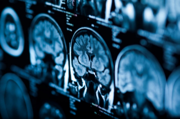 Icometrix Gets First CPT III Code Issued by AMA for AI Brain MRI Software