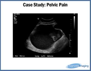 Pelvic Pain