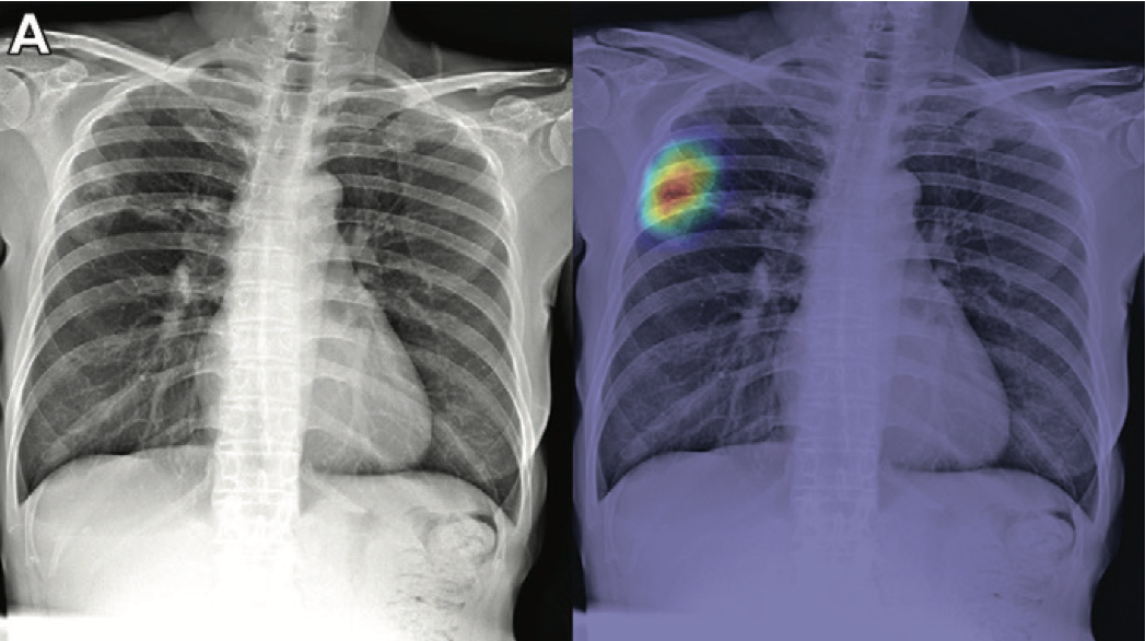 Chest X Ray Tb Test at Susan Burke blog