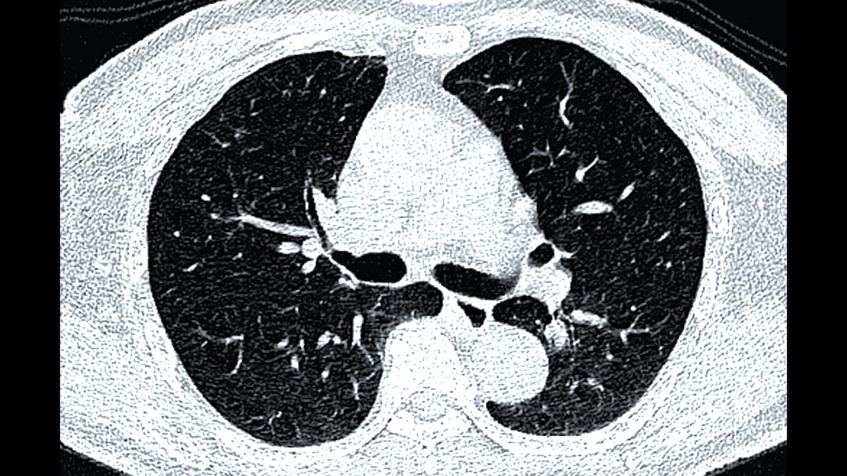 Do Significant Incidental Findings on Low-Dose CT Lead to Elevated Risks for Extrapulmonary Cancer?