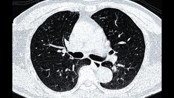 Do Significant Incidental Findings on Low-Dose CT Lead to Elevated Risks for Extrapulmonary Cancer?