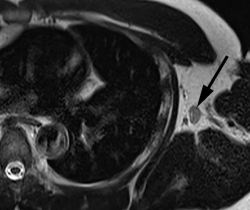 Post-Vaccine Axillary Lymphadenopathy: What a New Chest MRI Study Reveals