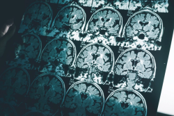 Could an MRI-Based Machine Learning Model Facilitate Enhanced Detection of Alzheimer's Disease?