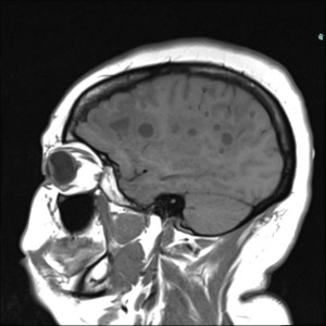 Image IQ: Patient with Vertigo, Episodic Dysarthria and Lower-Left Extremity Weakness