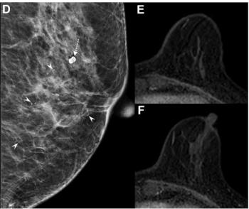 Post-NAC Breast MRI Without Calcifications Associated with 65 Percent Higher Likelihood of Pathologic Complete Response