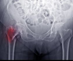 Study Looks at Deep Radiomics Approach for Diagnosing Osteoporosis on Hip X-Rays