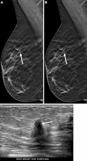 Mammography Study Shows Impact of AI-Powered Slab Reconstruction with DBT