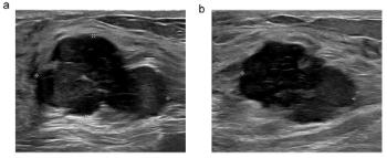 Can Breast Ultrasound AI Offer Comparable Sensitivity to Radiologists in Pregnant and Lactating Women?