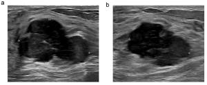 Can Breast Ultrasound AI Offer Comparable Sensitivity to Radiologists in Pregnant and Lactating Women?
