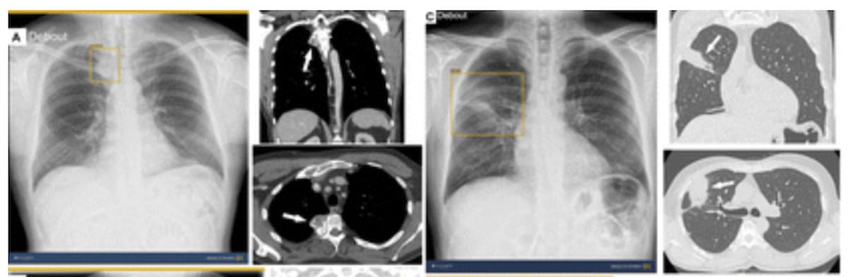 Study: AI Enhances Abnormality Detection on CXR Across Radiologist Experience Levels 