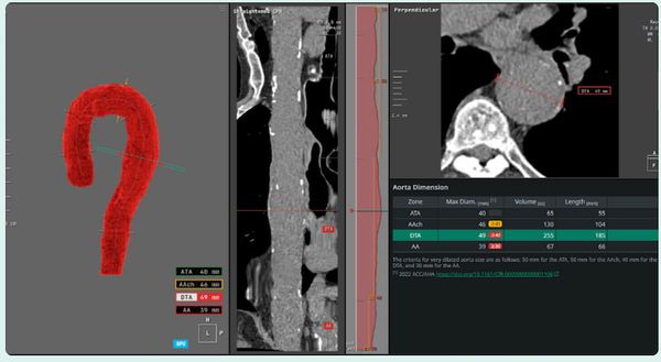 FDA Clears AI-Enabled Chest CT Software for Aortic Analysis
