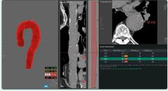 FDA Clears AI-Enabled Chest CT Software for Aortic Analysis