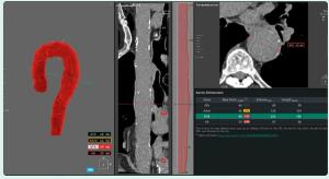 FDA Clears AI-Enabled Chest CT Software for Aortic Analysis