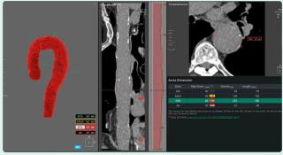 FDA Clears AI-Enabled Chest CT Software for Aortic Analysis
