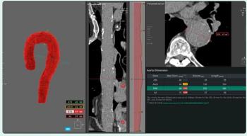 FDA Clears AI-Enabled Chest CT Software for Aortic Analysis