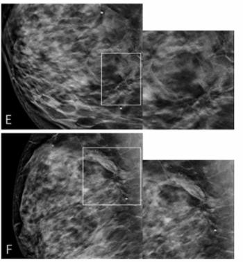 Digital Breast Tomosynthesis Study Assesses Impact of Architectural Distortion on Malignancy Rates