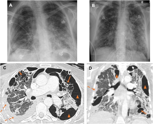 New Chest Imaging Study Finds Intrathoracic Complications in 20 Percent of Patients with COVID-19