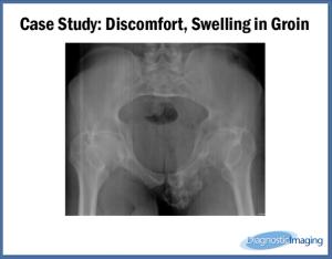 Discomfort, Swelling in Groin