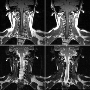 Recurrent Thyroid Cancer with Epidural Metastases