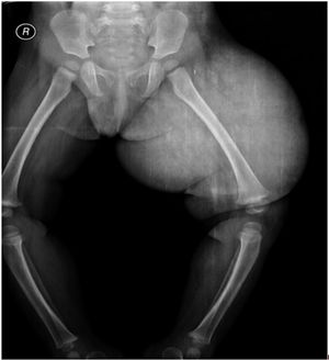 Rare Case of Lymphangioma