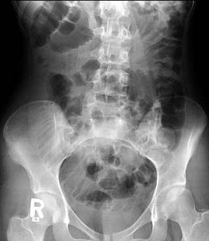 Adenocarcinoma of the Small Bowel