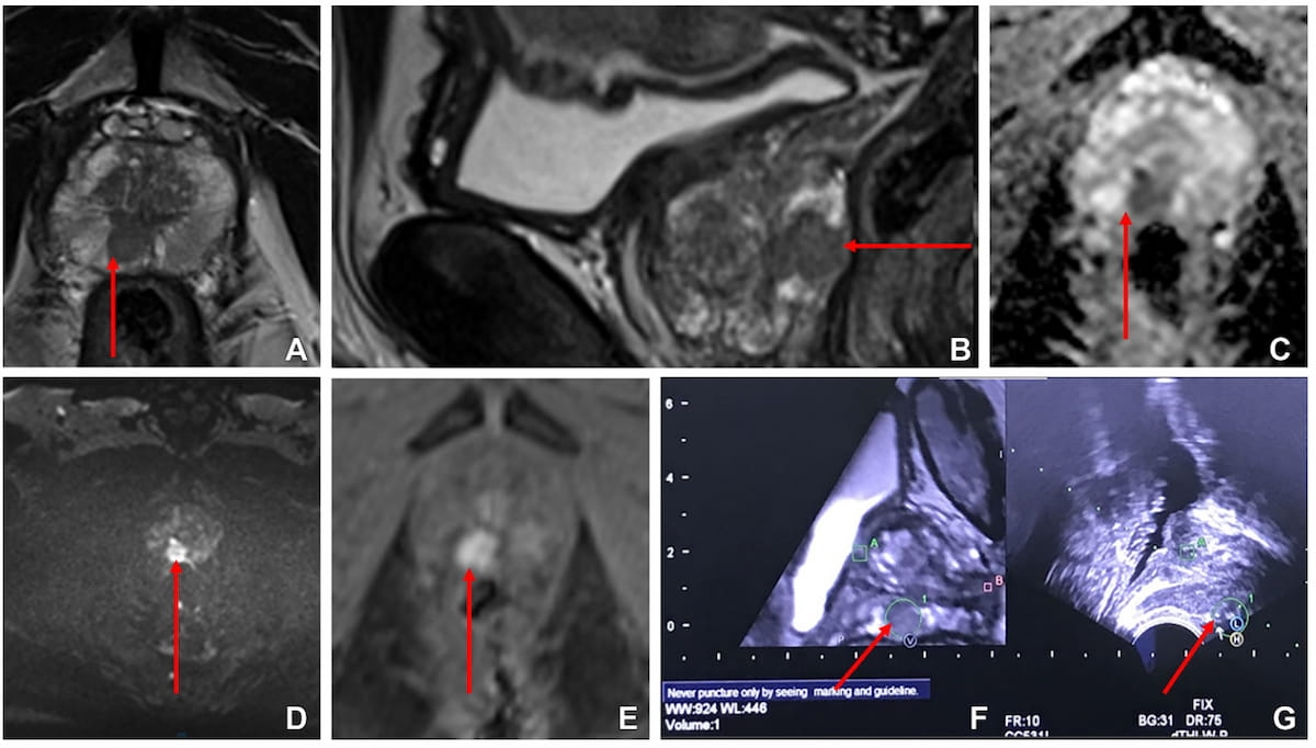 Study: Combination of Ultrasound and MRI-Targeted Biopsy Enhances Detection of Prostate Cancer